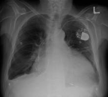 http://blogs.computerworld.com/sites/computerworld.com/files/u185/embedded_implanted_pacemaker.png
